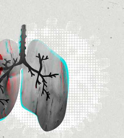 Sarcoidosis