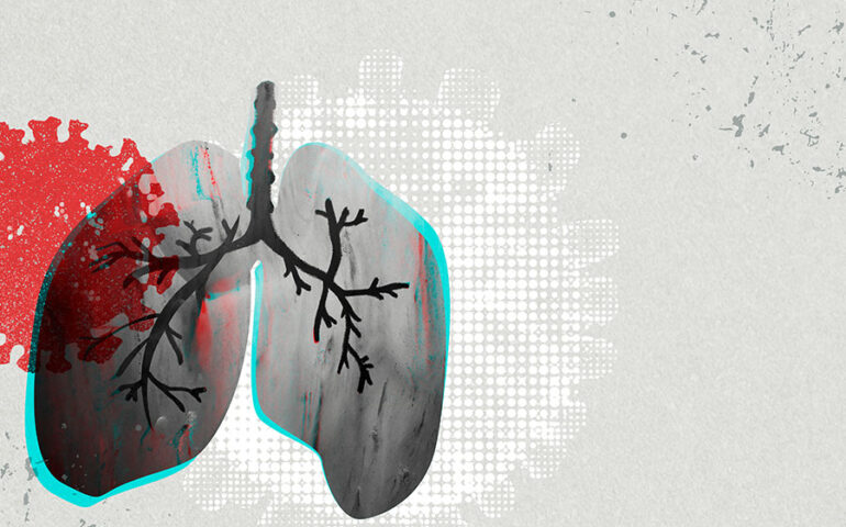Sarcoidosis_MAIN_1