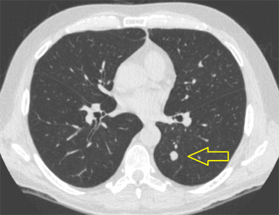 lung-scan